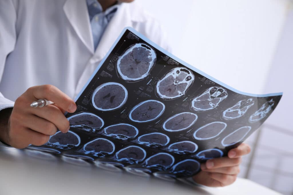 photo of a doctor analyzing an MRI scan showing a brain to treat glioblastoma